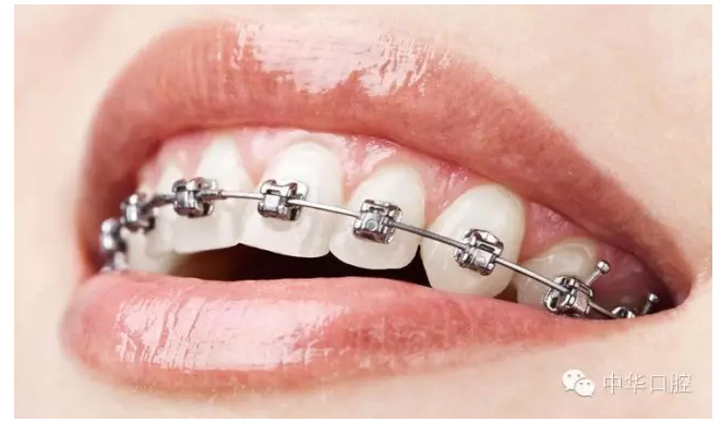 “蝴蝶效应”：牙齿不齐引起的连锁反应