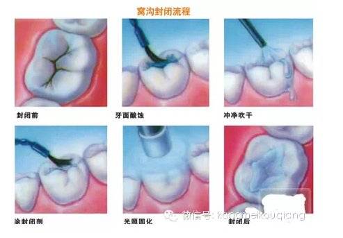 口腔窝沟封闭，就如同给牙齿穿上了一层保护衣，使牙齿免受食物侵蚀。原理：窝沟封闭后，窝沟内原有的细菌断。