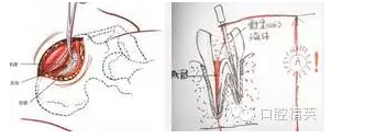 根管髓腔渗血的常见原因及处理方法