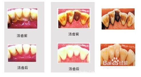 洗牙的详细步骤