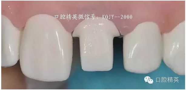为什么你的牙齿备不好