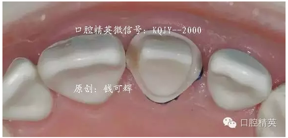 为什么你的牙齿备不好