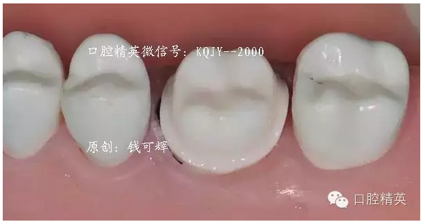 为什么你的牙齿备不好