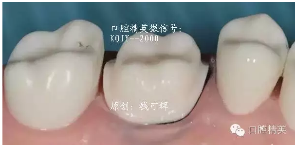 为什么你的牙齿备不好