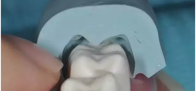 为什么你的牙齿备不好