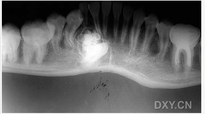 牙源性钙化囊肿    牙瘤!