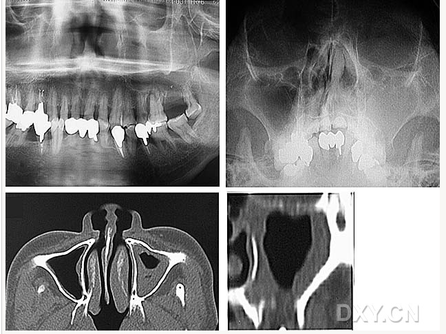 大理石骨病（下颌骨有明显的骨化影像，恒牙埋伏）