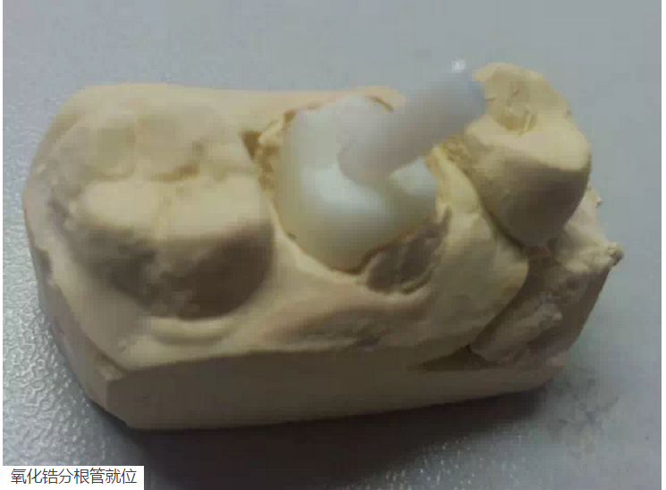氧化锆桩核后牙根管有倒凹设计
