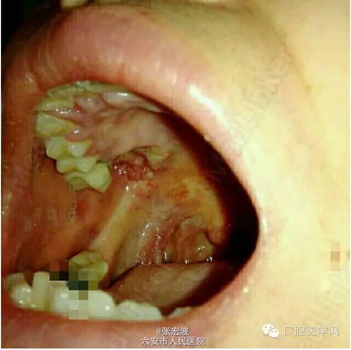 牙龈癌