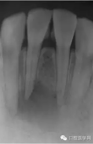 常规根管治疗成功处理根尖周病变较大牙齿