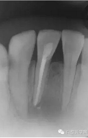 常规根管治疗成功处理根尖周病变较大牙齿