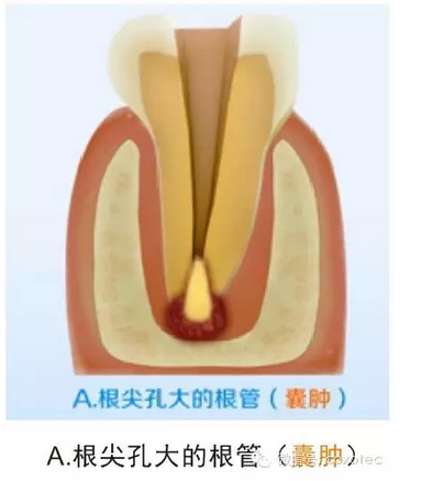 让你知道根管测量受影响的原因