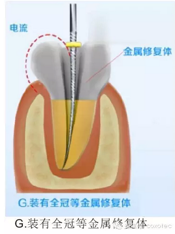 让你知道根管测量受影响的原因