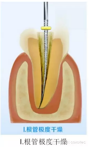 让你知道根管测量受影响的原因