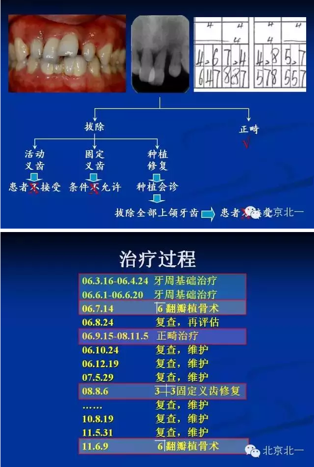 牙周基础治疗的临床病例介绍