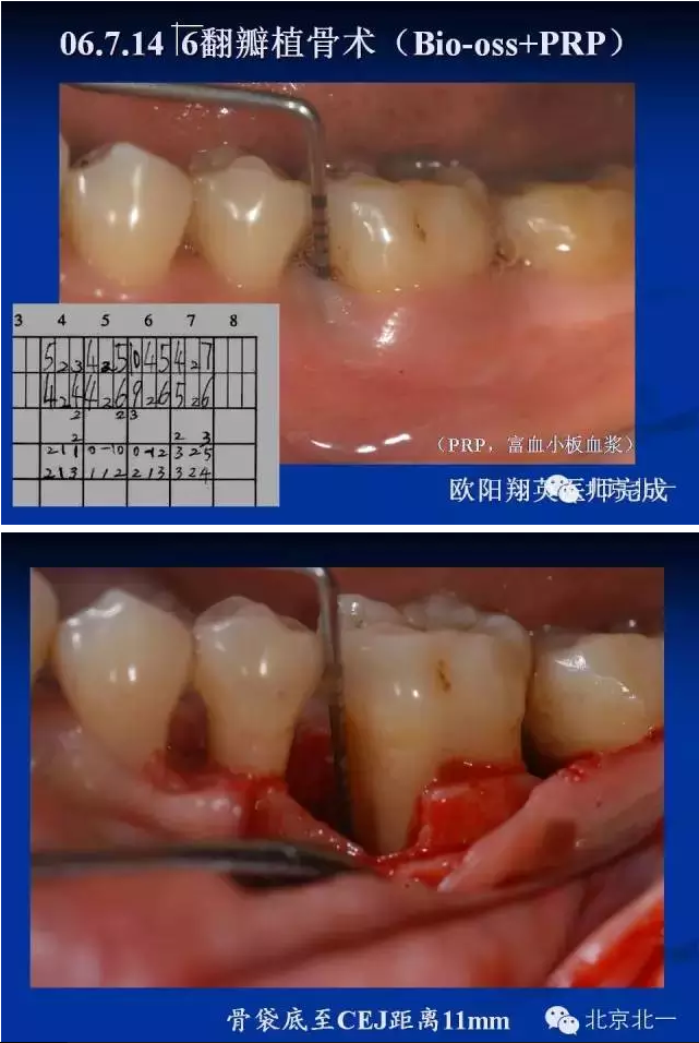 牙周基础治疗的临床病例介绍