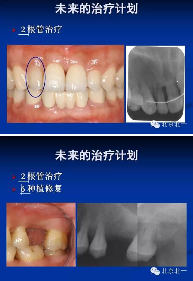 牙周基础治疗的临床病例介绍