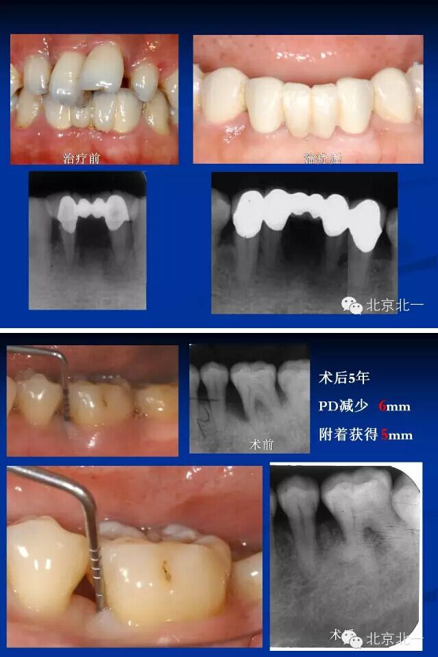 牙周基础治疗的临床病例介绍