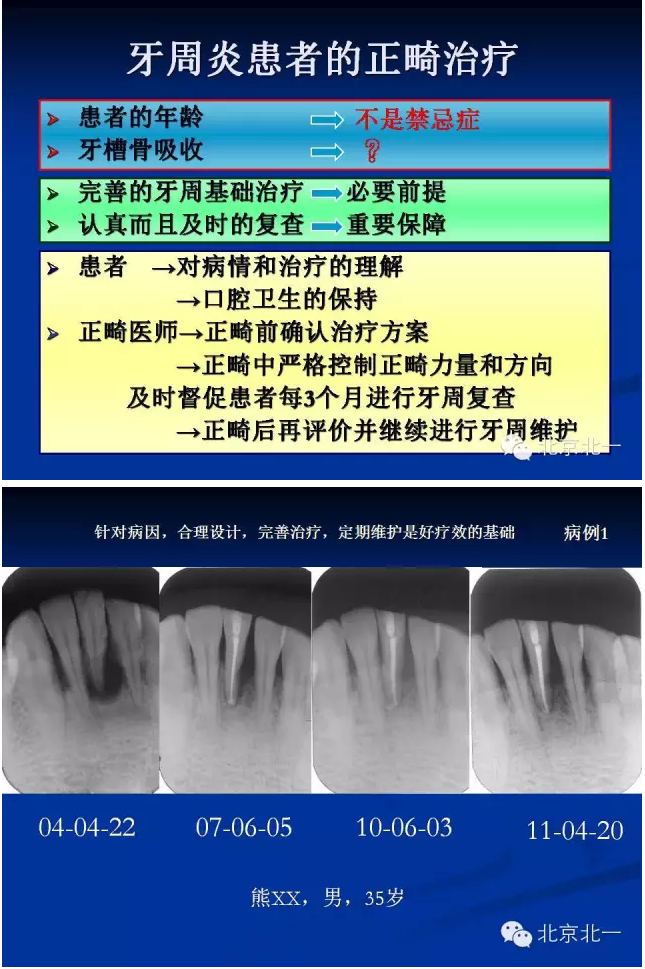 牙周基础治疗的临床病例介绍