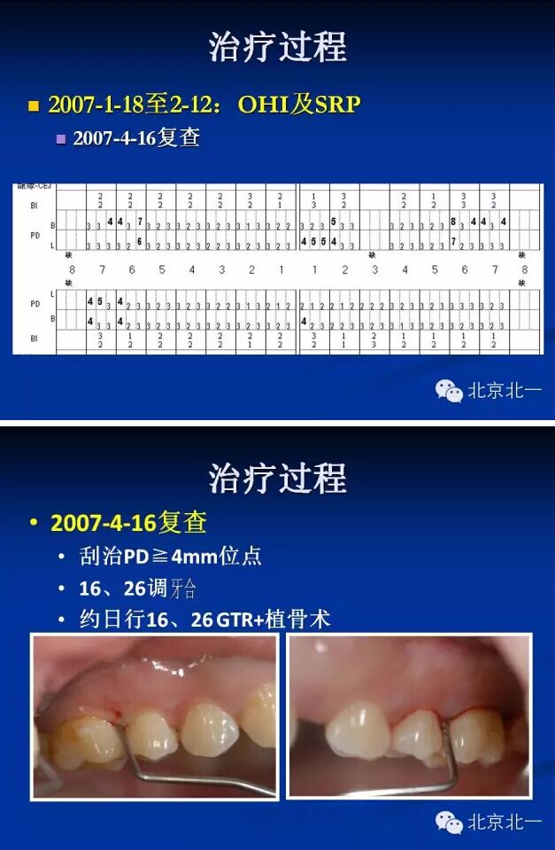 牙周基础治疗的临床病例介绍