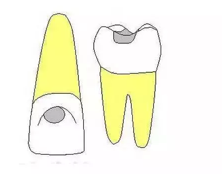 龋齿龋洞的5种类型