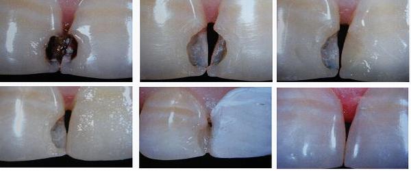 各类牙洞型树脂修复