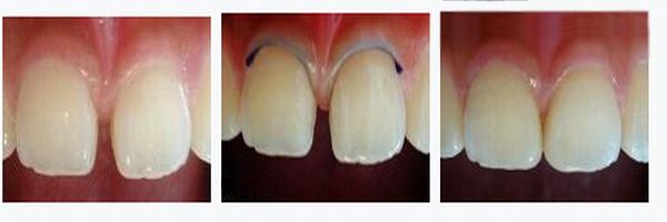 各类牙洞型树脂修复