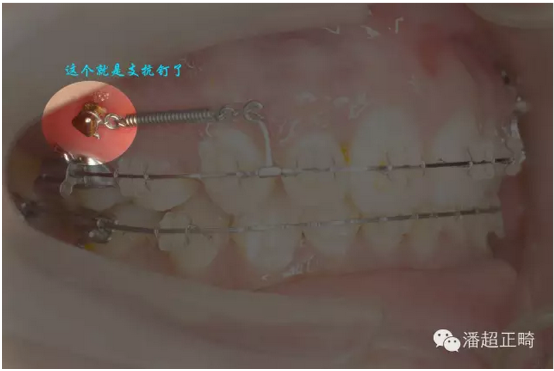 【口腔正畸】支抗钉的植入其实不会那么恐怖
