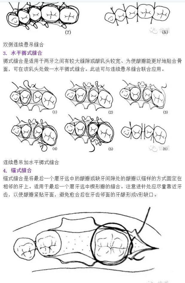 牙医基本技能：口内缝合术（文字、示意图及视频）