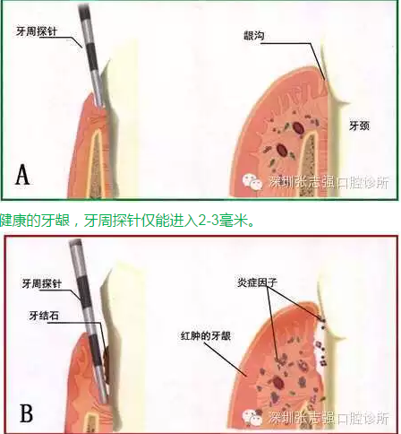 刷牙出血，牙龈红肿，并非缺乏维生素