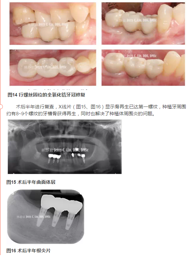 最后再进行种植牙修复,本案例是以螺丝固位的全氧化锆牙冠来做为