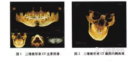 将牙体纵向剖开后,可见融合牙为2个单独髓腔和1个共同的根管系统(图3)