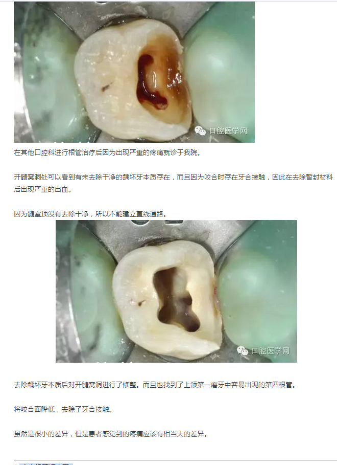 上颌后牙开髓1例