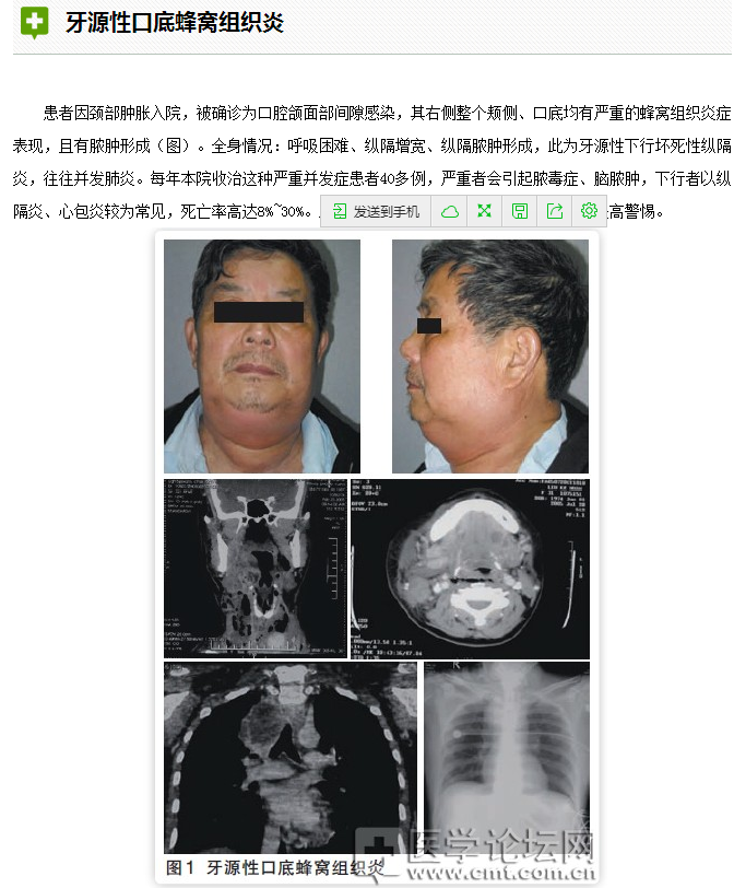 口腔疾病与全身系统性疾病的关系