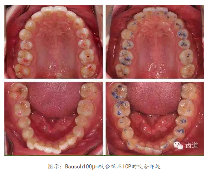 牙科咬合纸的用法