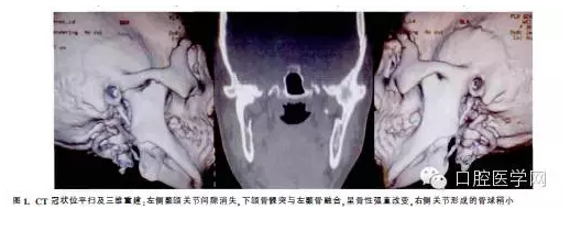 全身(远处)感染致颞下颌关节强直:1例报告及文献复习