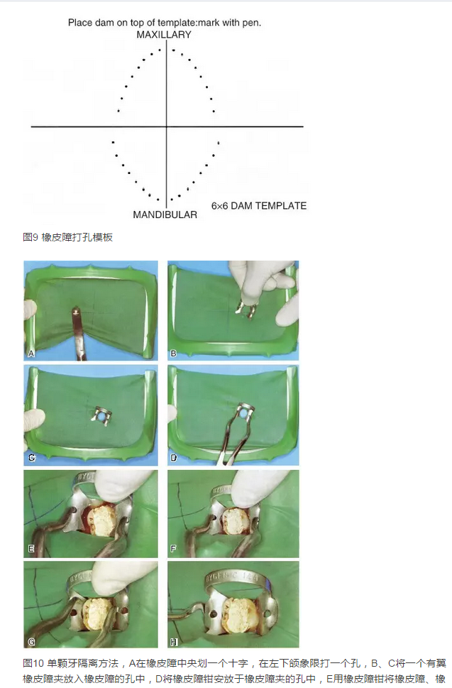 橡皮障隔离之单颗牙隔离方法——陈智教授