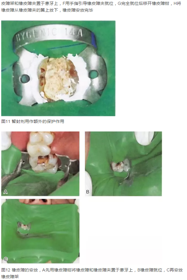 橡皮障隔离之单颗牙隔离方法——陈智教授
