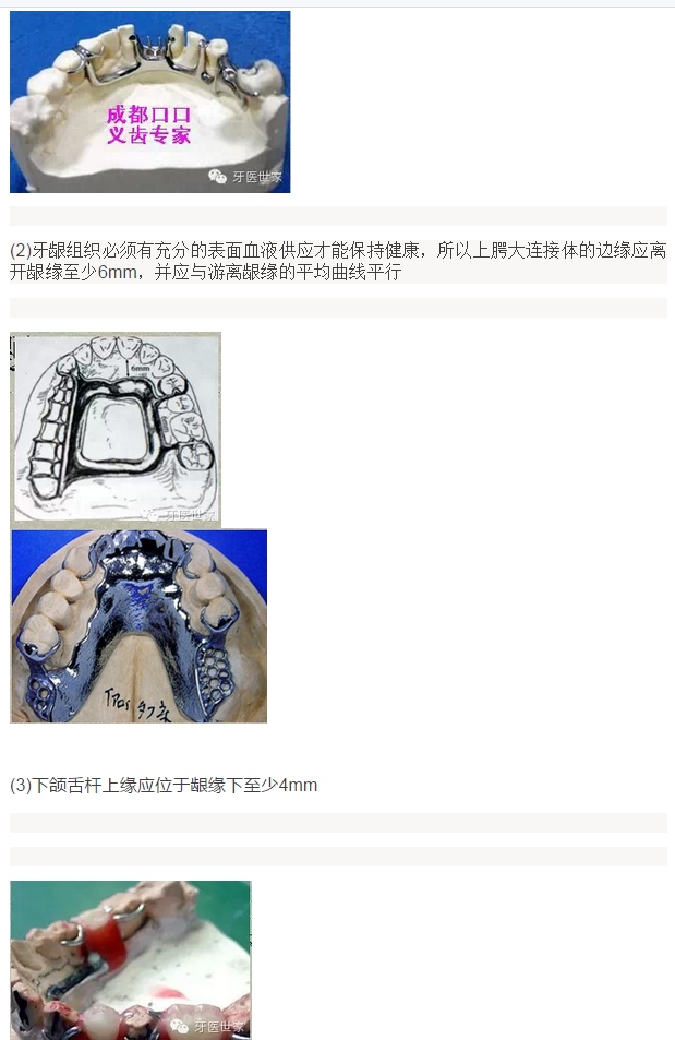 活动义齿支架设计的常见错误及预防