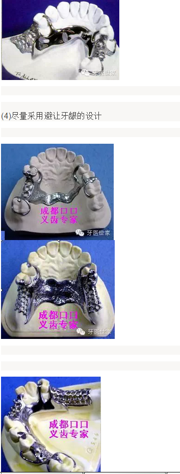活动义齿支架设计的常见错误及预防