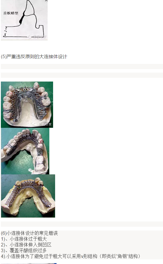 活动义齿支架设计的常见错误及预防