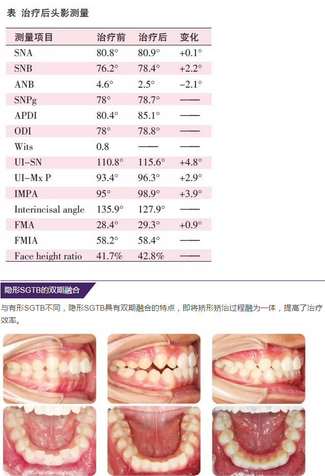 首例隐形sgtb矫治病例报告