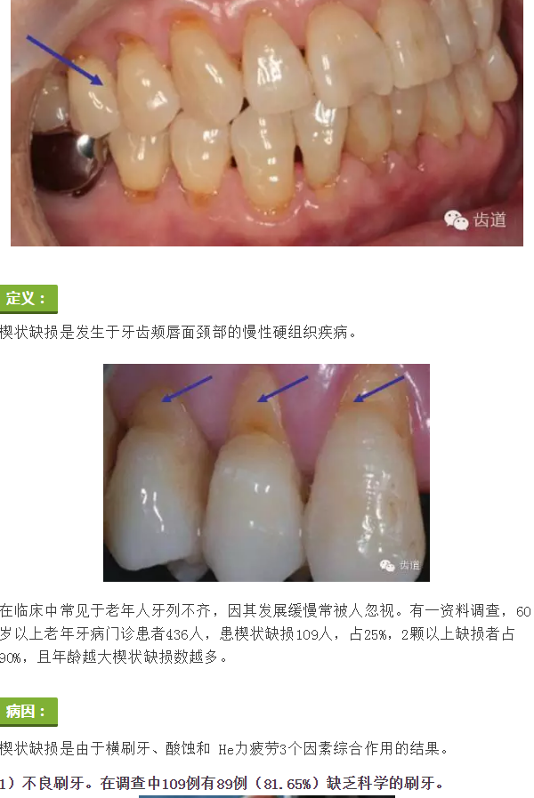 简析牙颈部楔状缺损修复