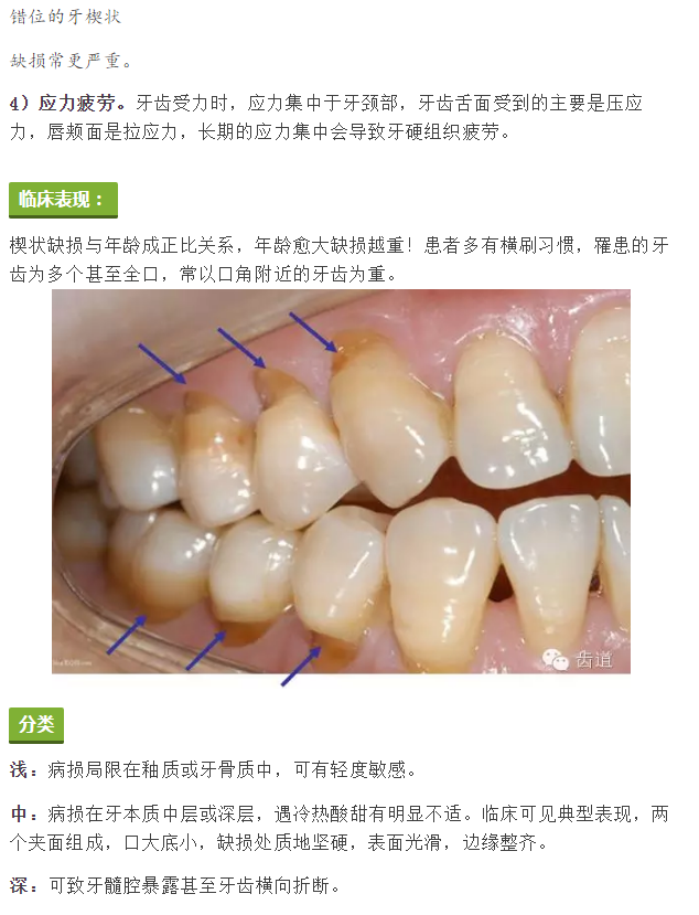 简析牙颈部楔状缺损修复