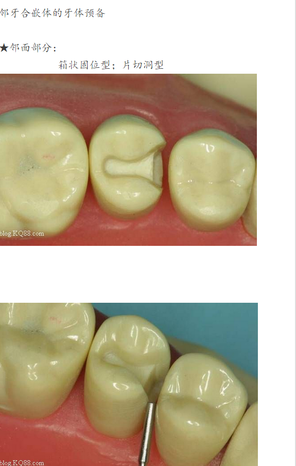 嵌体牙体预备方法
