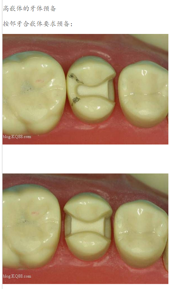 嵌体牙体预备方法