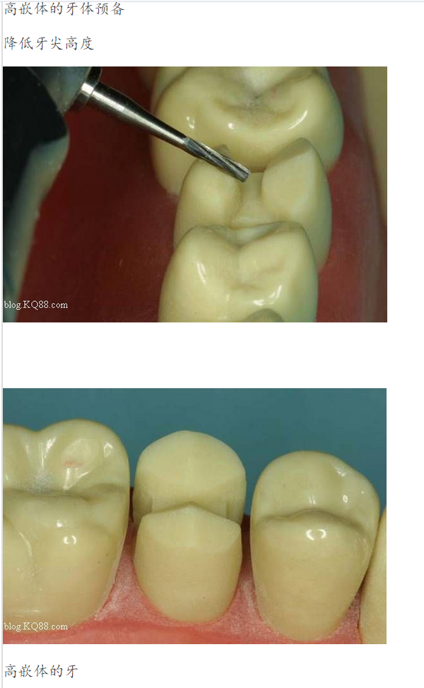 嵌体牙体预备方法