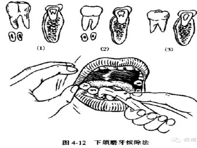 10,下颌第一,二磨牙