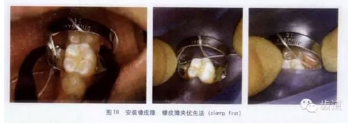 橡皮障的临床运用大全 橡皮障的临床运用大全