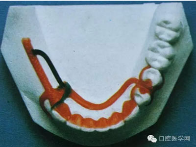 中常见的卡环种类及作用  常用于后牙游离端缺失,基牙为双尖牙或尖牙